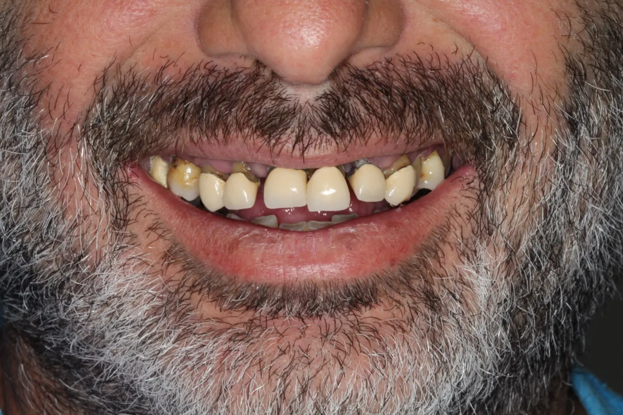 Antes del tratamiento: dentadura deteriorada con piezas ausentes y desgastadas. Caso real de Dentaláser