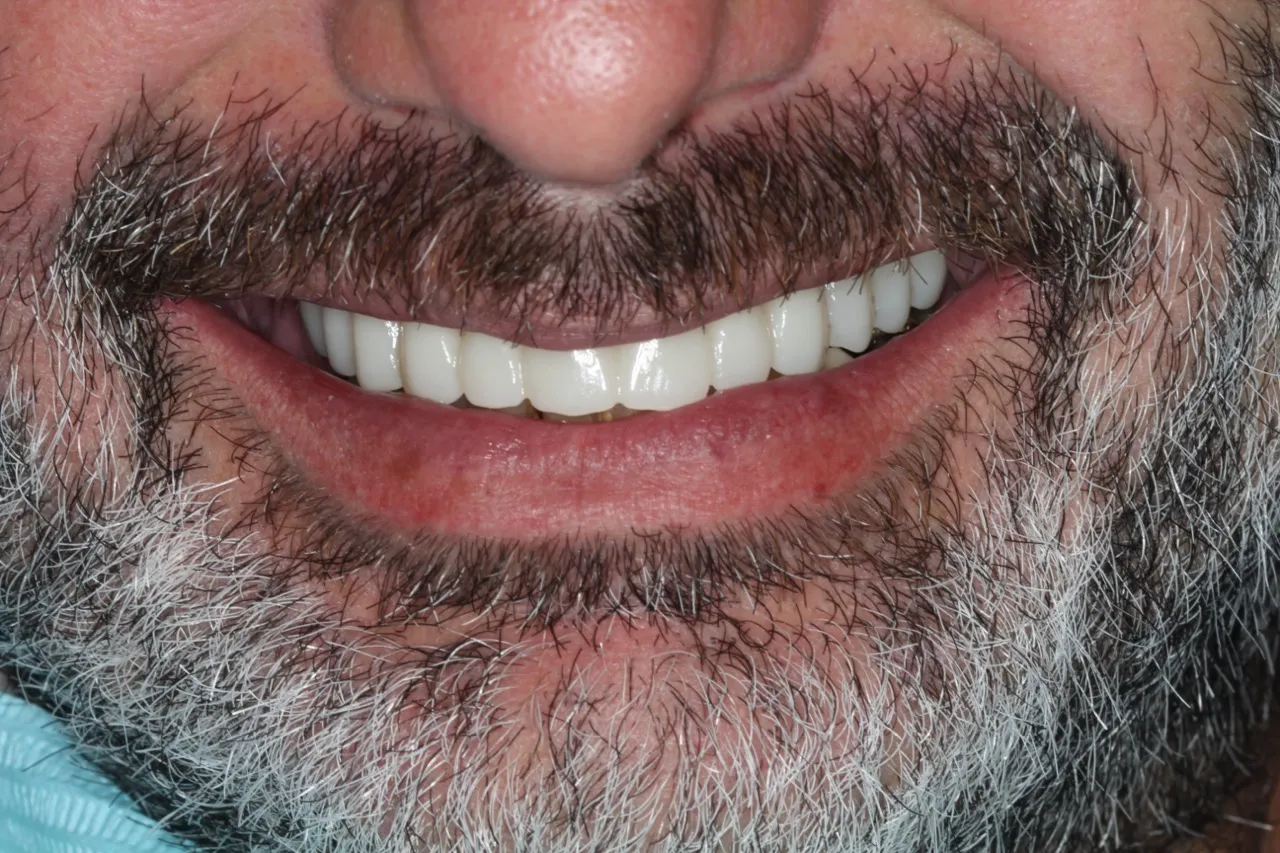 Después del tratamiento: sonrisa completa rehabilitada. Mismo paciente, tratado por el Dr. Alberto Cerezo