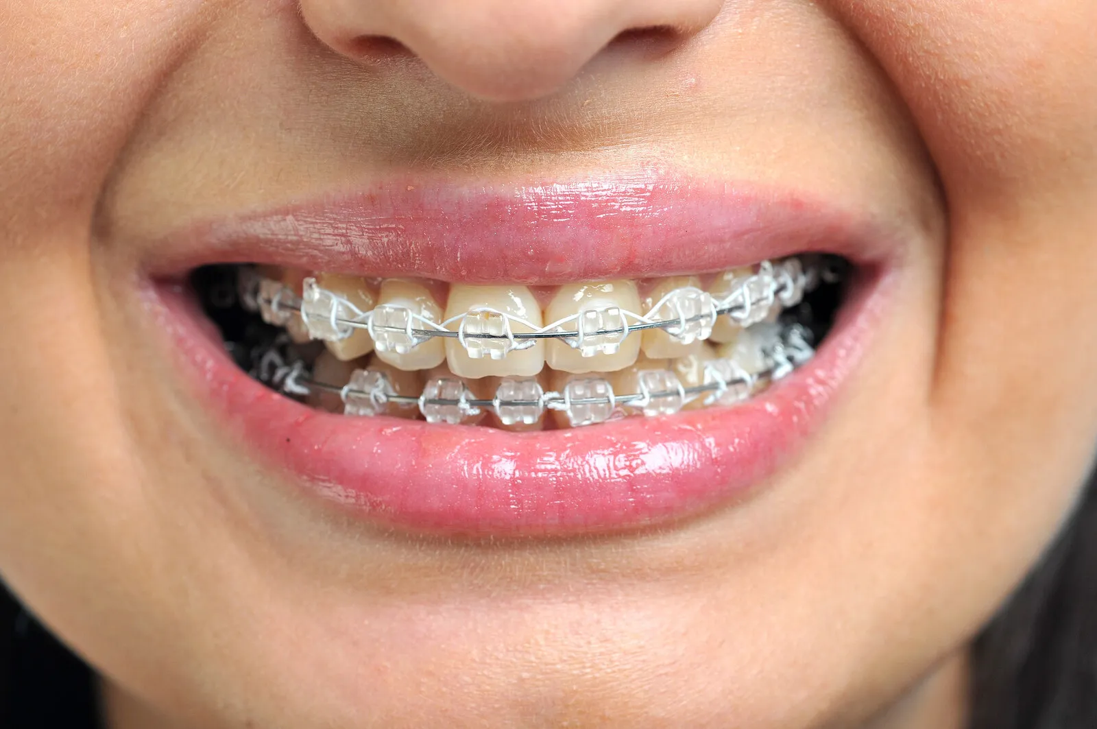 Brackets de cerámica Dentaláser