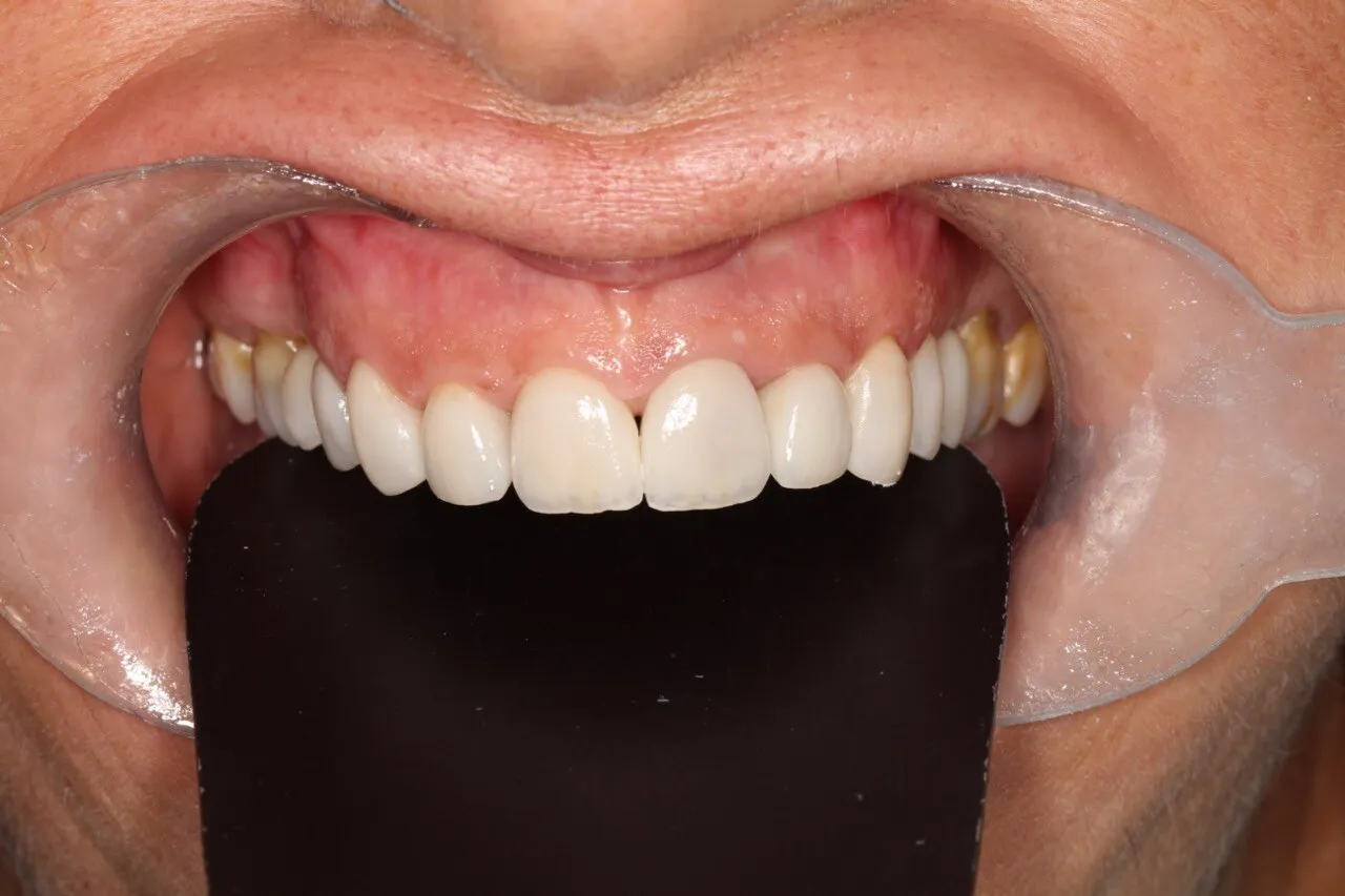 Carillas de porcelana Dentaláser