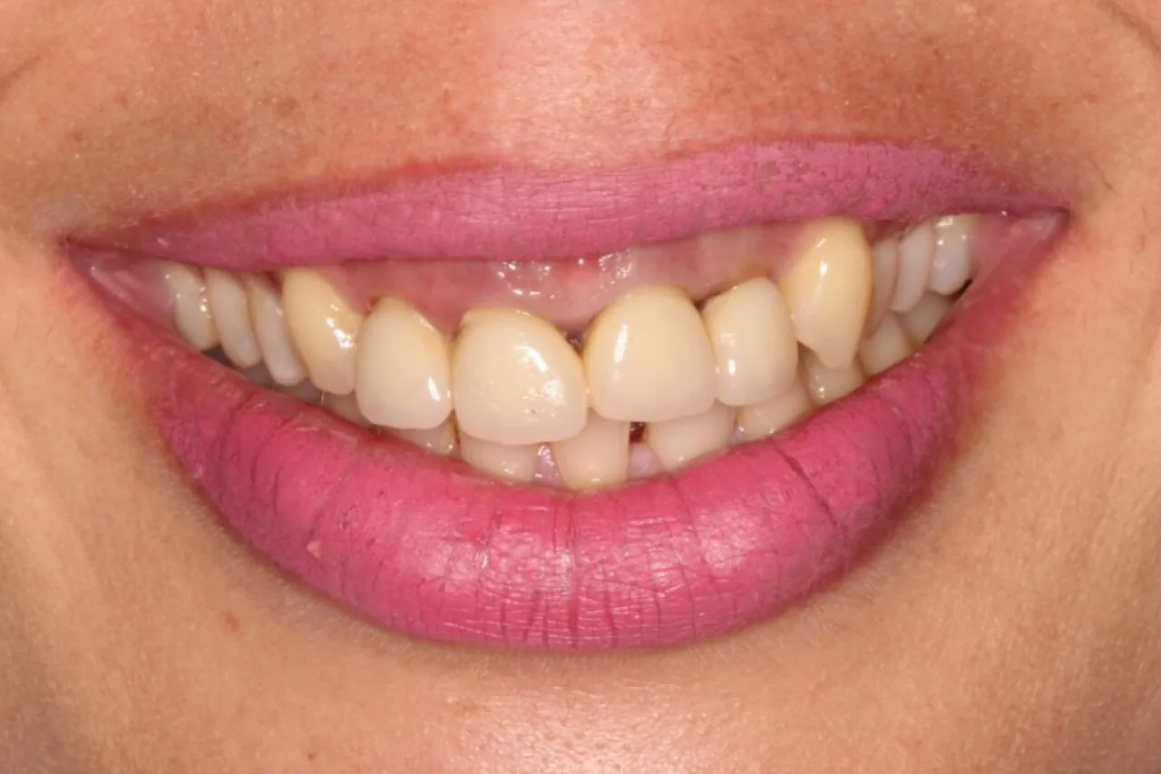 Primer plano de una sonrisa, base sobre la que se planifica un diseño de sonrisa digital