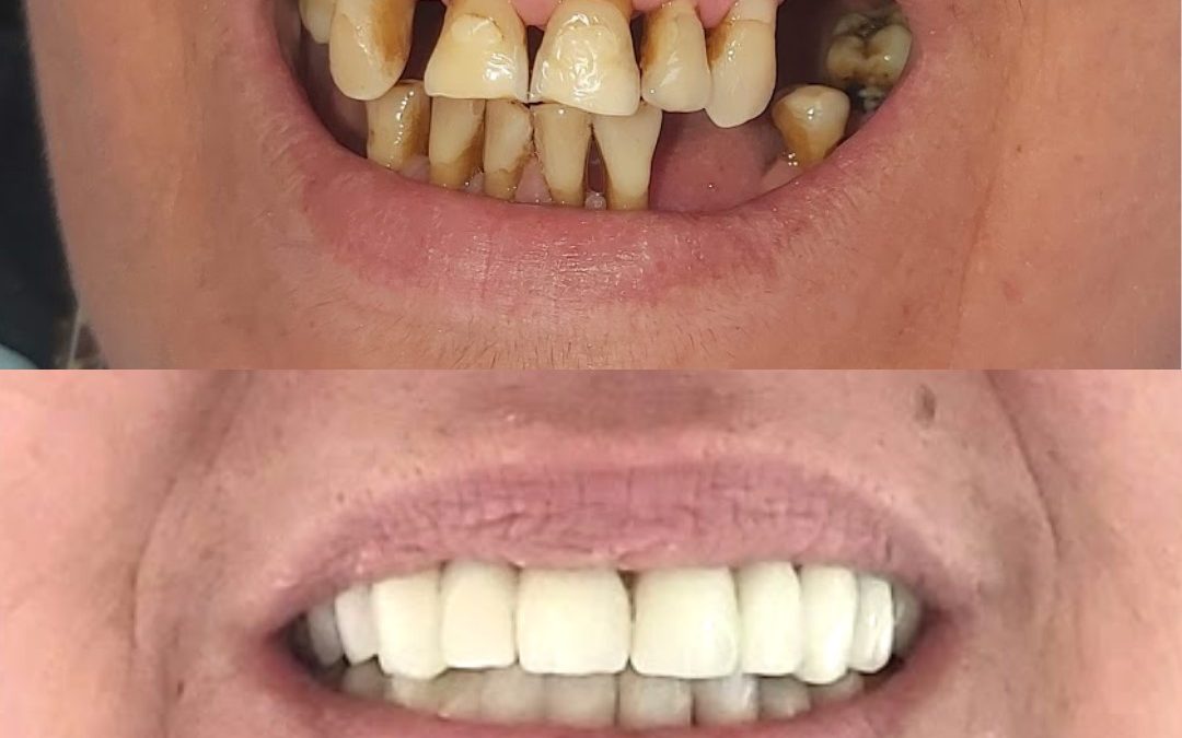 Ceramic crowns and removable cosmetic prostheses