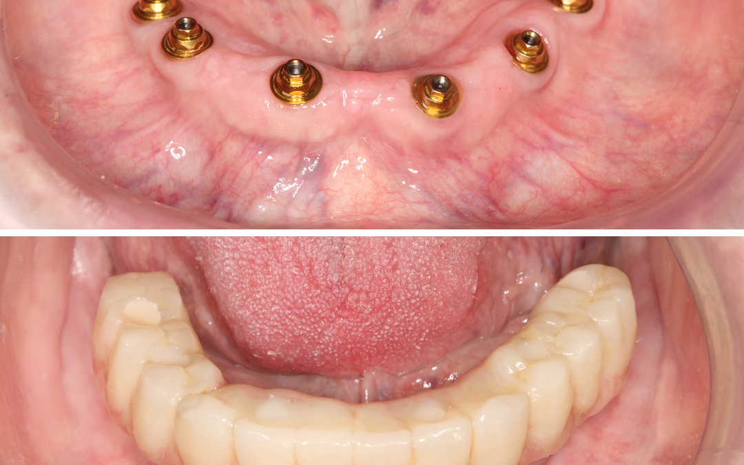 All on six. Implantology.