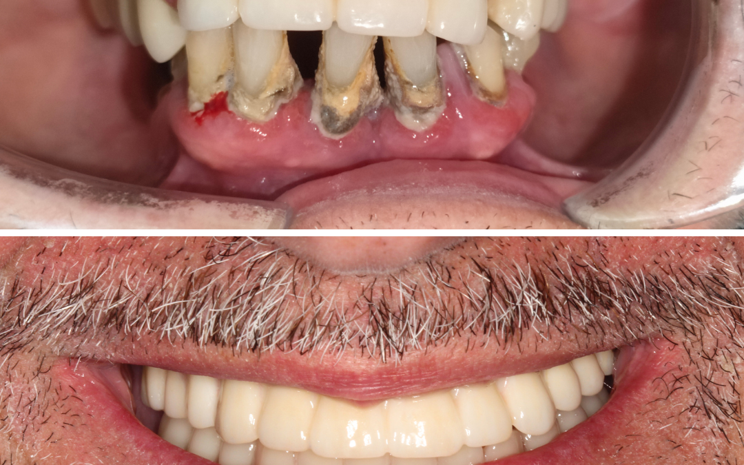 Full mouth. Implantología dental.