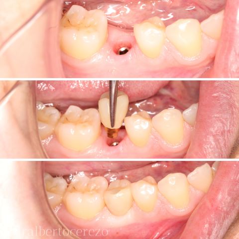 Implante dental unitario. Protocolo 100% digital.