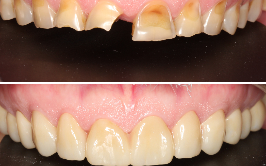 Tooth wear. Treatment = Crowns.